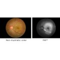 Non Mydriatic & Mydriatic Retinal Camera FAF(Fundus Auto-Fluorenscence)