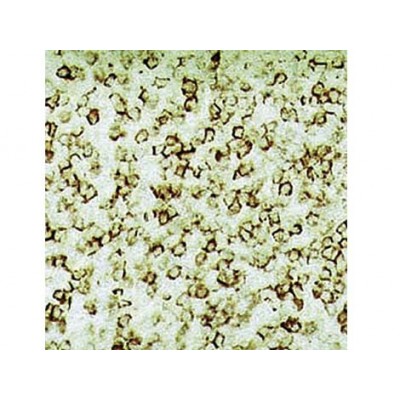 Hairy Cell Leukemia , DBA.44 , IgM - 1ml