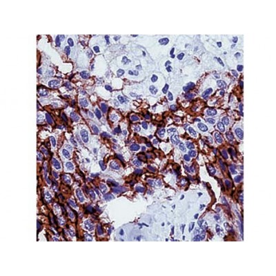 Mesothelioma , HBME-1 , IgM - 0.5ml