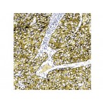 Melanoma Pan , Cocktail , IgG - 0.5ml Melanoma Pan , Cocktail , IgG - 0.5ml